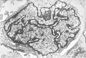 M, 11y. | mycosis fungoides v.s. - cerebriform nucleus of Sézary cell M, 11y. | mycosis fungoides v.s. - cerebriform nucleus of Sézary cell